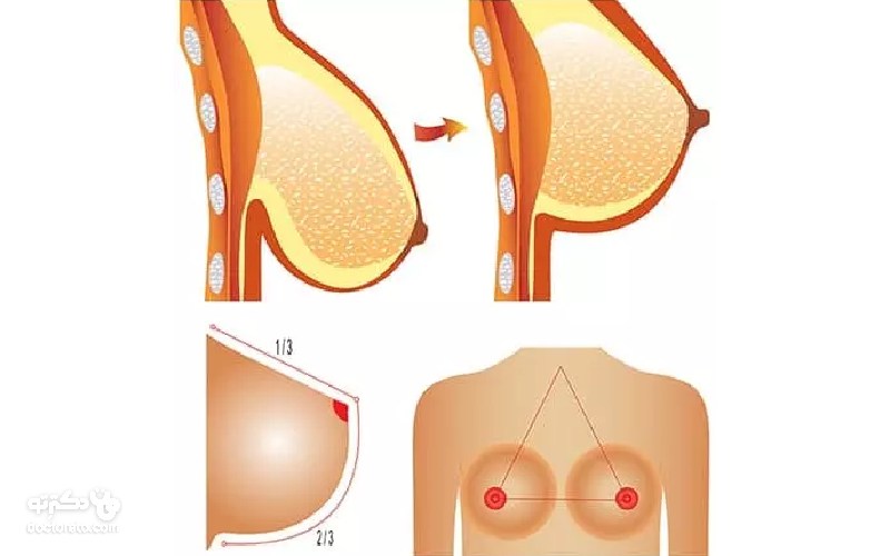 ژل سینه ساختار نسبتا طبیعی دارد