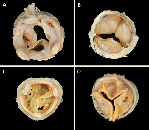 biological_heart_valve