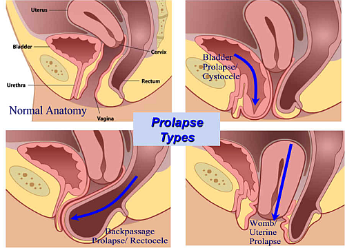 vaginal prolapse types