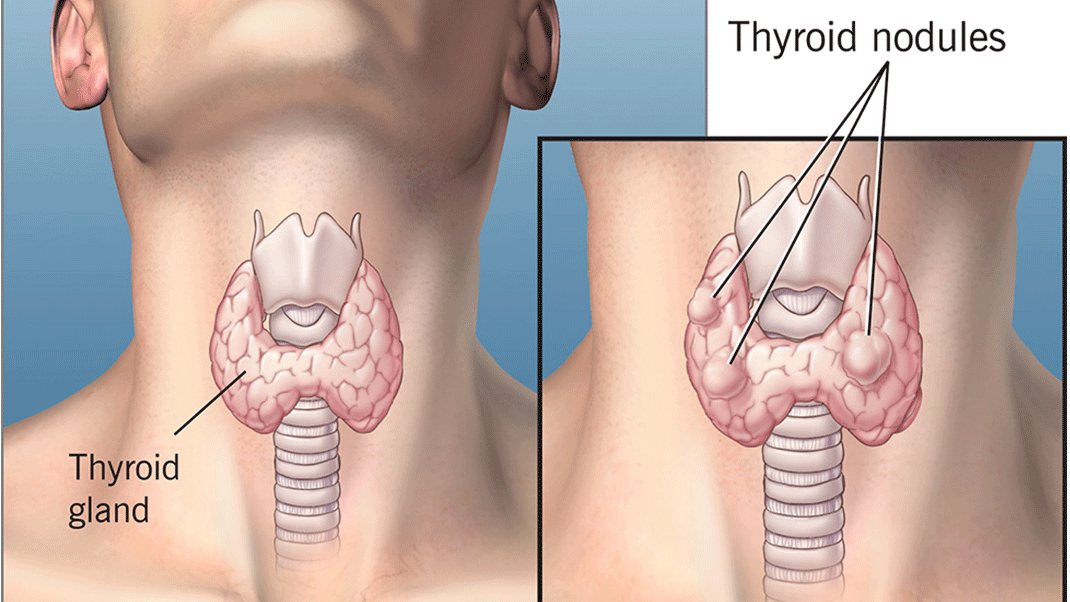 Diagnosis of thyroid nodule disease