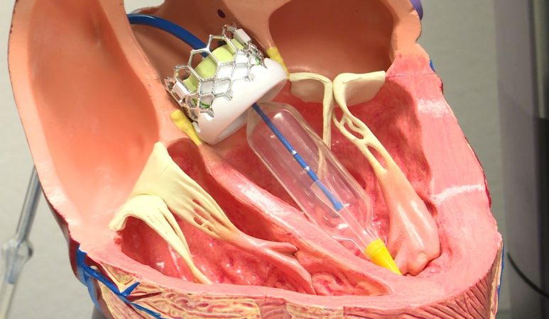 tavr