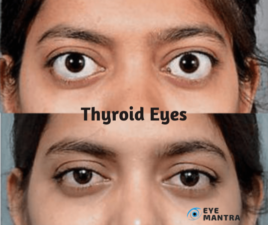 thyroid-eye-disease