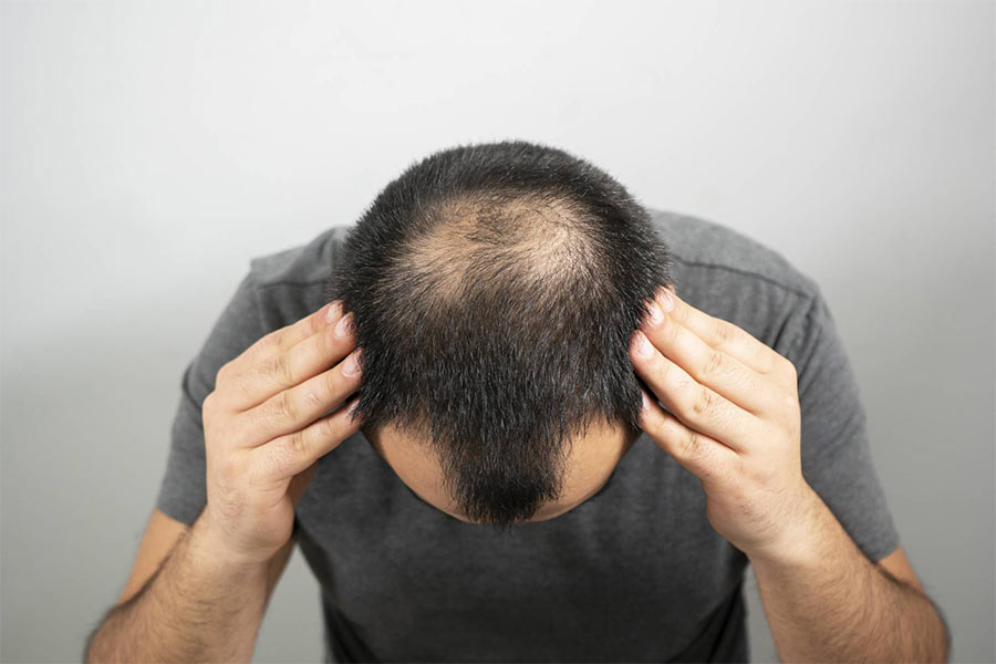 کاشت مو برای درمان ریزش مو مردان