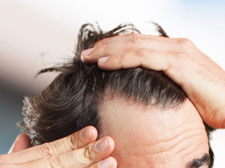 Treatment-of-hair-loss-in-men