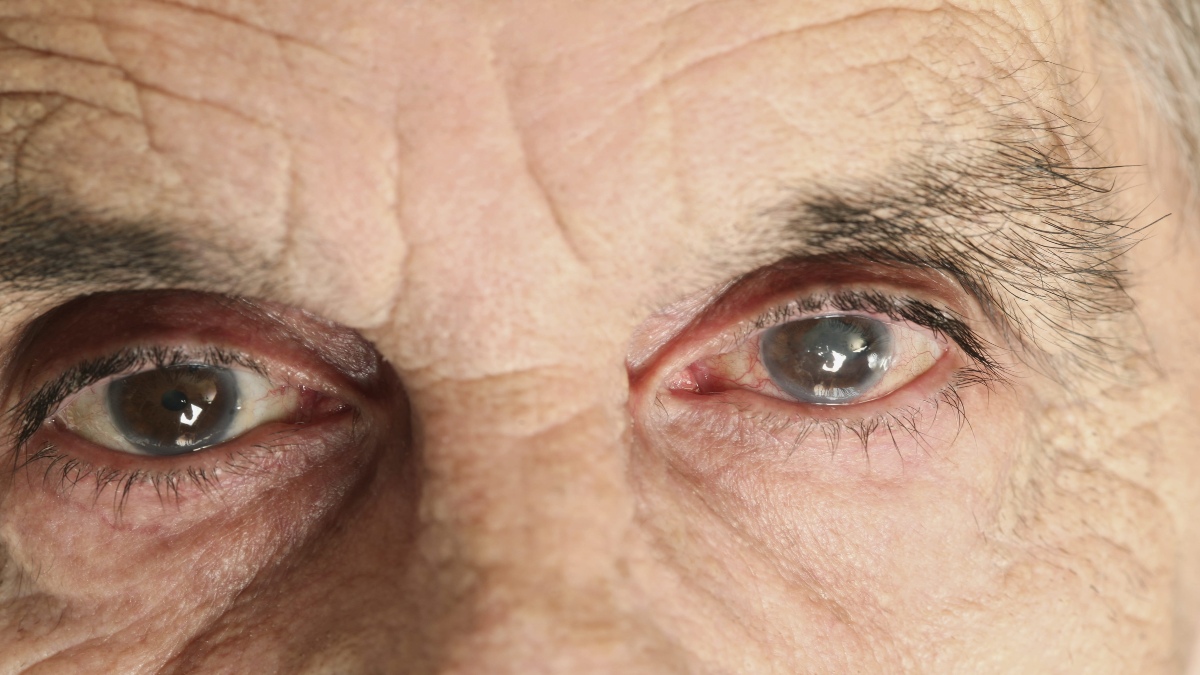 Cataract Eyes