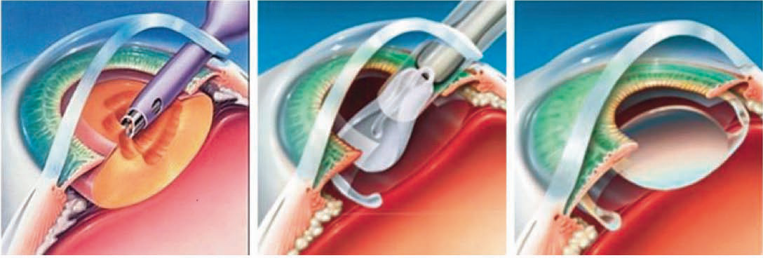  iol Implants surgery