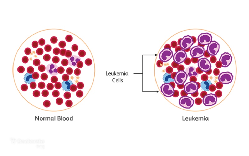 آزمایش سرطان خون، تفسیر و نحوه انجام آزمایش سرطان خون