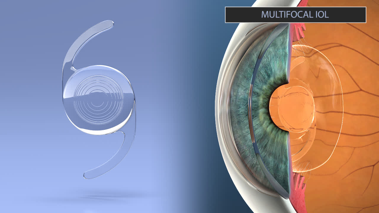 Intraocular Lens Implants 