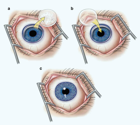 Corneal Transplant Surgery