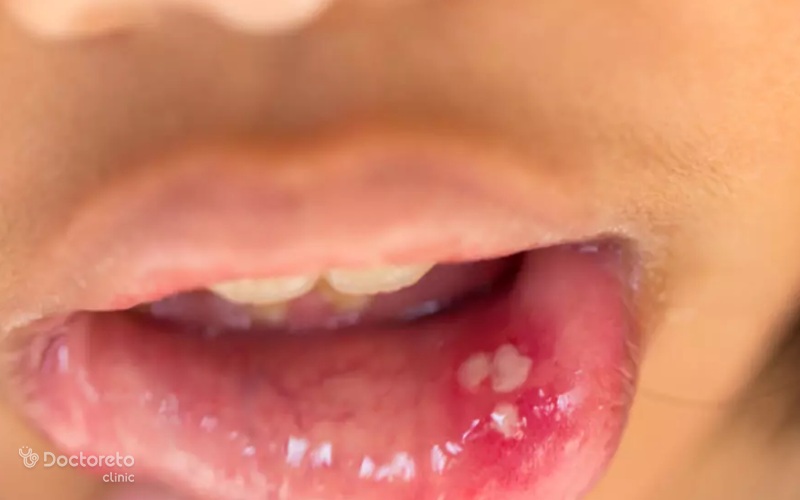 درمان زخم دهان چیست؟