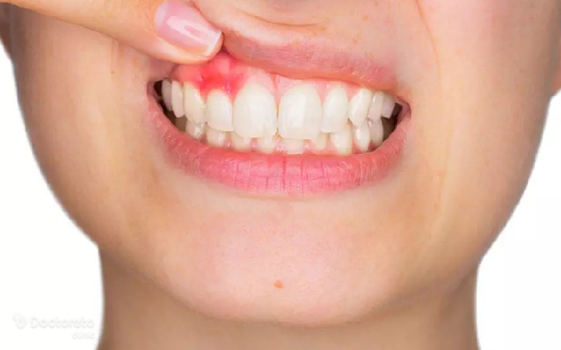 علت زخم دهانی چیست