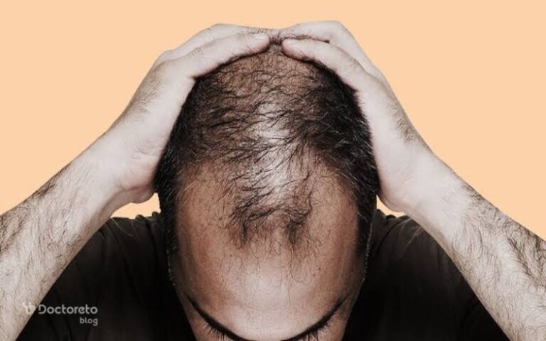 علت ریزش مو در مردان چیست؟
