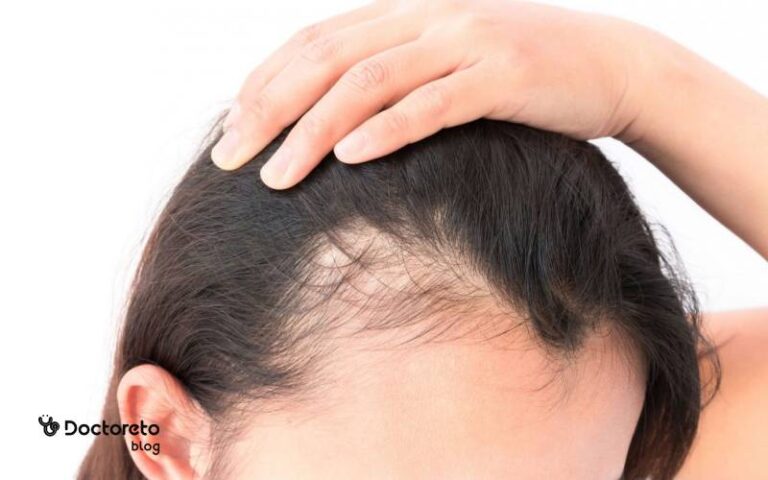 علت ریزش مو در زنان چیست؟