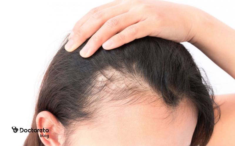 علت ریزش مو در زنان چیست؟
