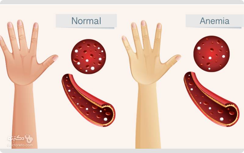 از دلایل اصلی MCHC پایین آنمی است