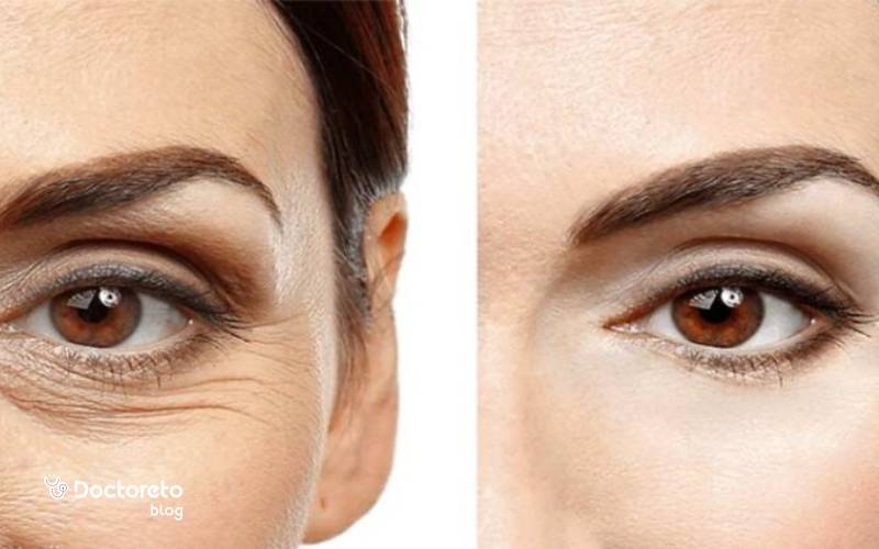 جدیدترین عمل زیبایی چشم