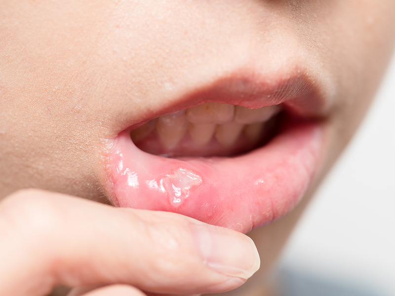 MOUTH ulcer