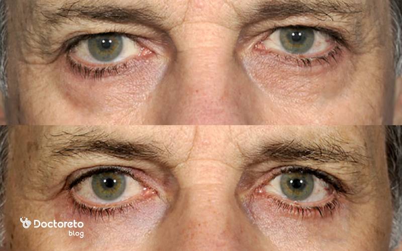 Conjuff جراحی با invasion