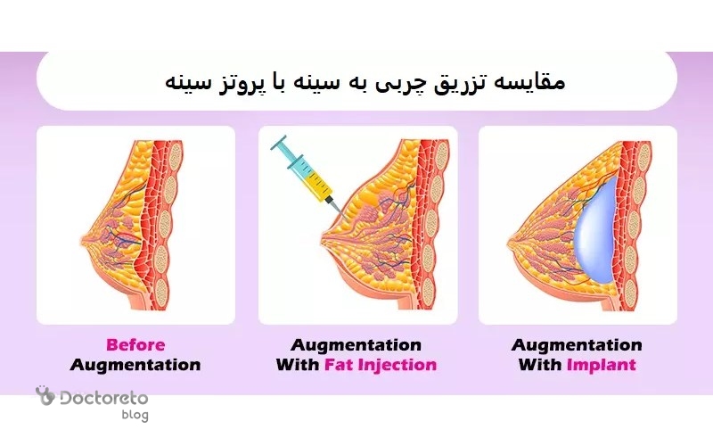 تزریق چربی به سینه