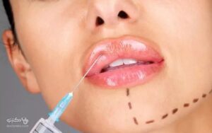 تزریق ژل، روشی مطمئن برای زیبایی صورت و بدن
