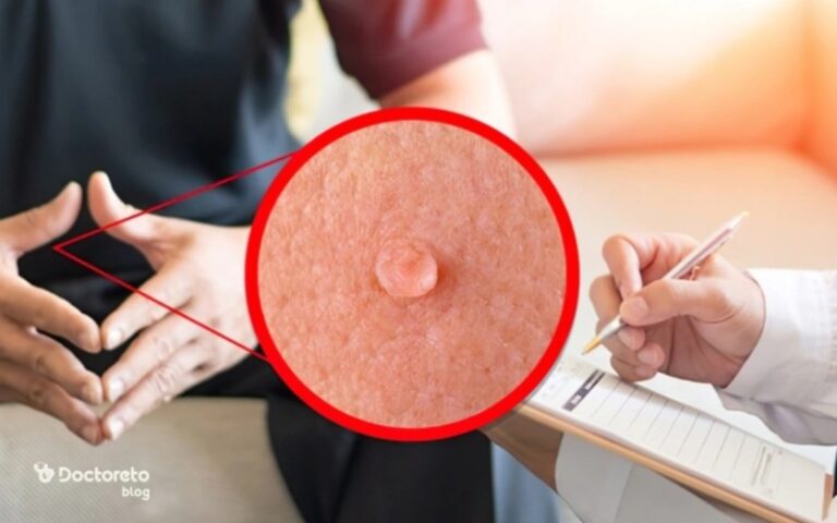 زگیل تناسلی چیست و چرا به وجود می‌ آید؟