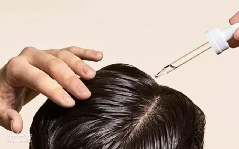 ماینوکسیدیل یکی از معروف ترین داروهای ضد ریزش مو