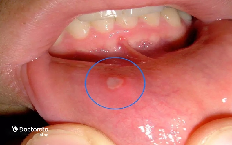 آفت زخم داخل دهان