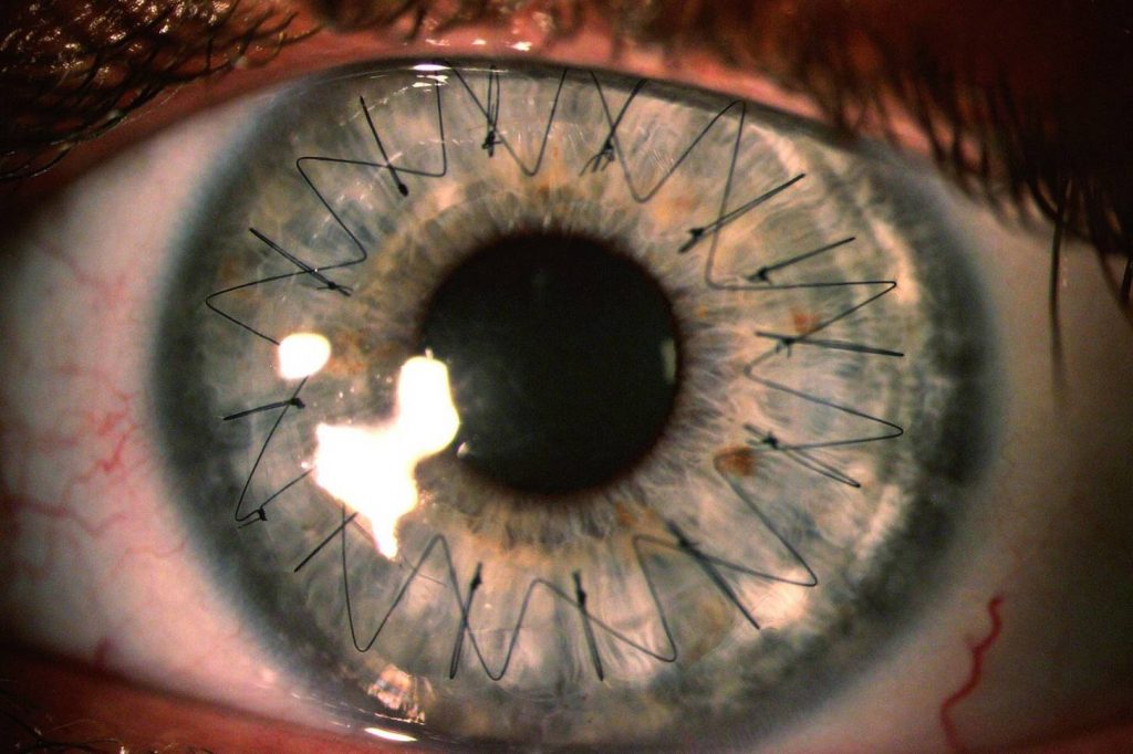 Corneal transplant operation