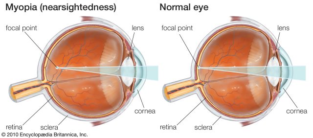 nearsighted-eye