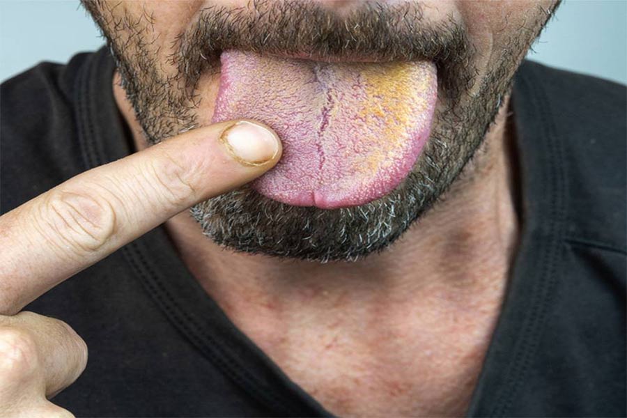 عوامل خطر زردی زبان