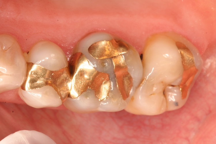 gold dental filling