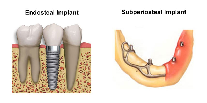 dental implants types
