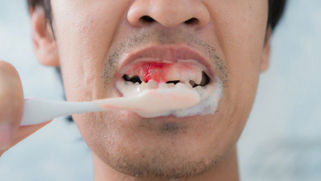 bleeding gums AFTE TEETH BRUSHING