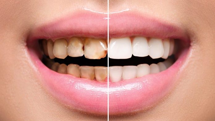 composite-dental composite dental