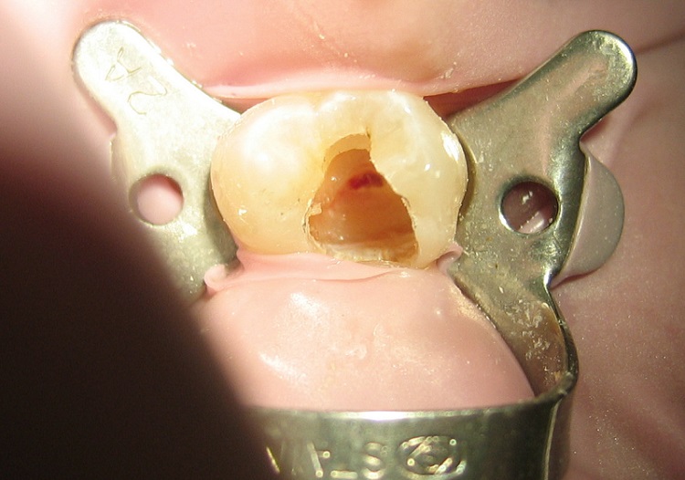 یکی از جراحی های درمانی دندان عصب کشی است. 