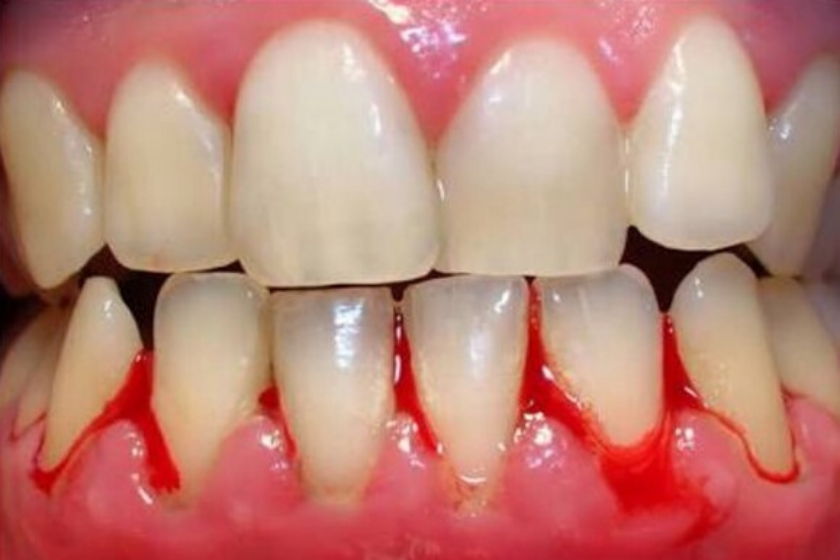 infection and bleeding gums