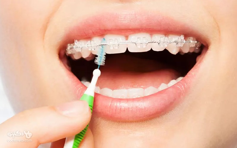 بریس های دندانی را چطور تمیز کنیم؟
