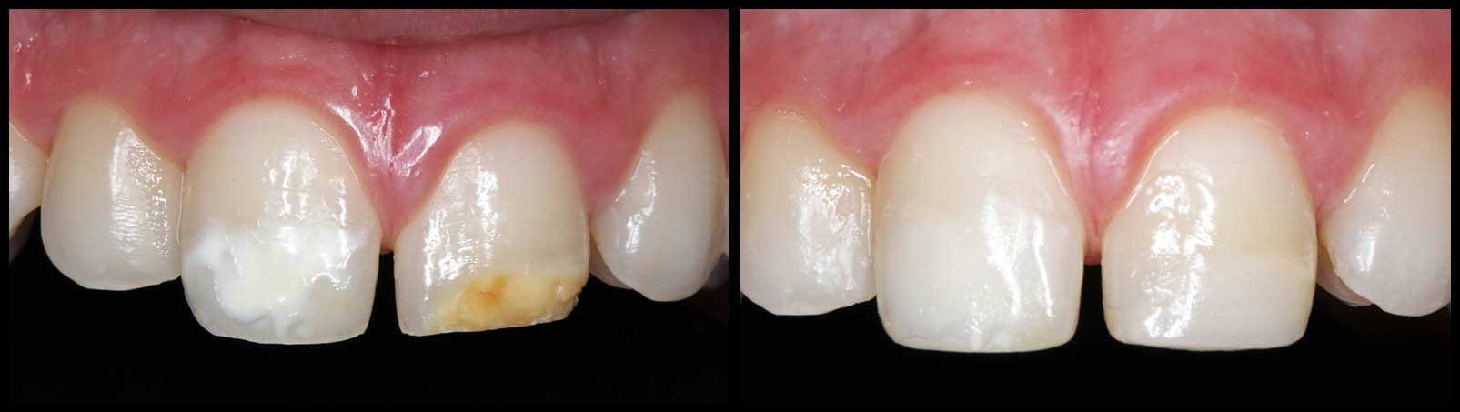 composite dental