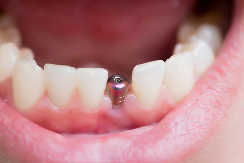 یکی دیگر از انواع جراحی دندان ایمپلنت است