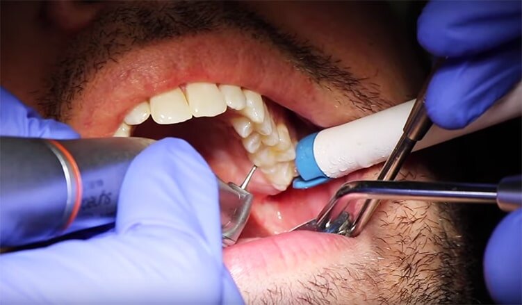 dentist filling cavitiy