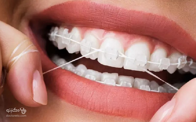 چطور ارتودنسی را نخ دندان بکشیم؟