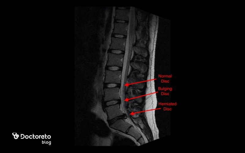 عکس پارگی دیسک کمر