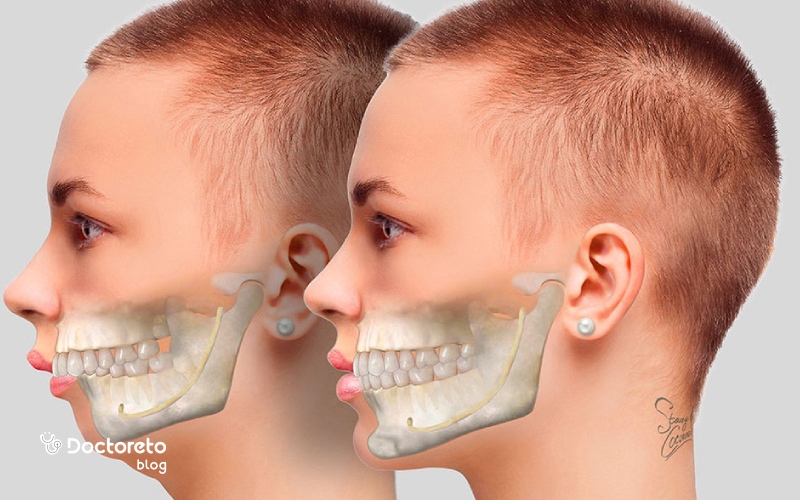 جراحی فک برای چه کسانی مناسب است؟