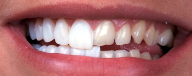 dental composite before after