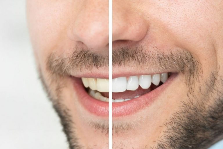 teeth whitening