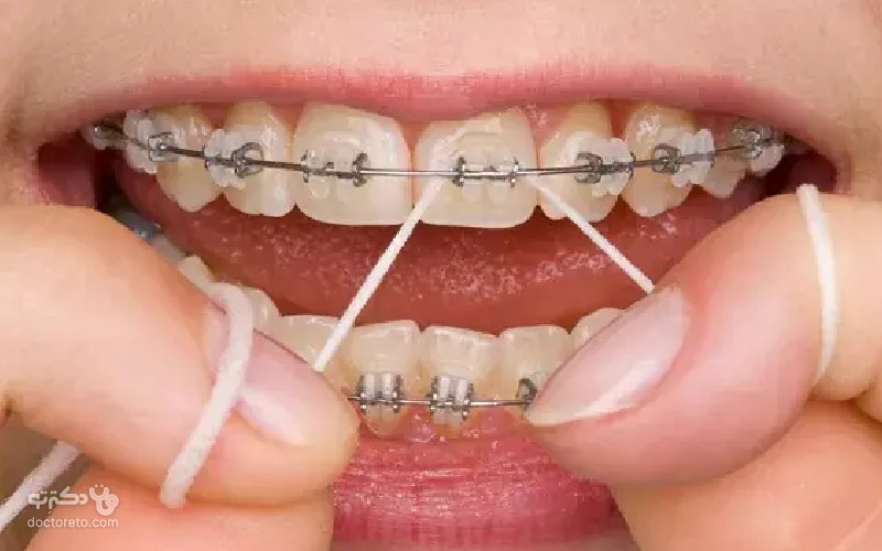نخ دندان ارتودنسی چیست؟