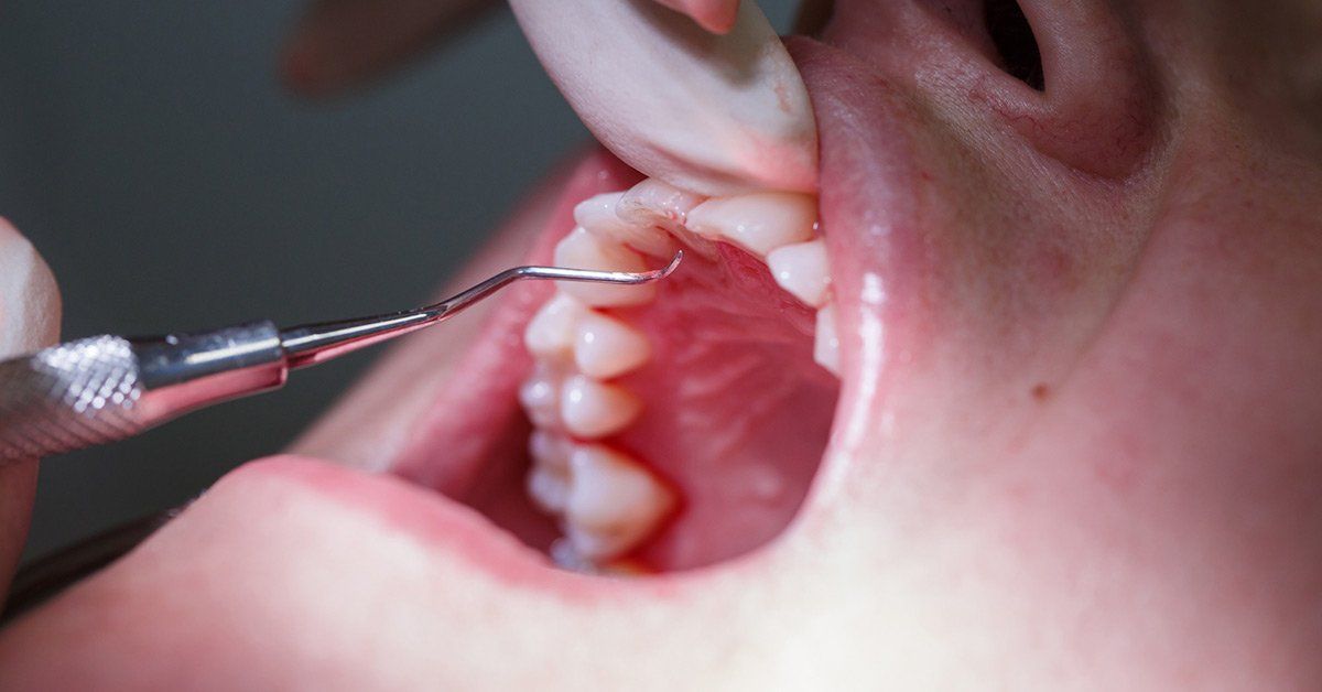 Infection and bleeding gums