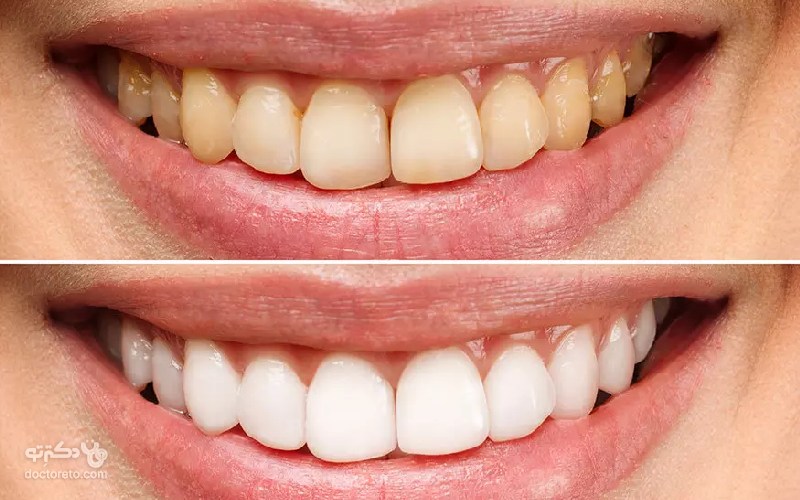 بلیچینگ یکی از روش های سفیدکردن دندان است