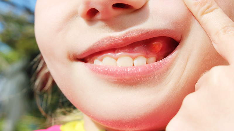 INFECTION IN GUMS