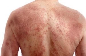 Allergic eczema